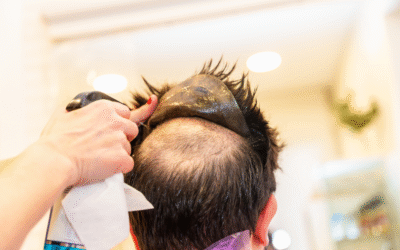 Hair Fixing vs. Hair Transplant: Which Is Right for You?