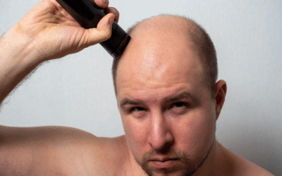 Tips for Maintaining Hair & Scalp Health Before Getting Hair Patches