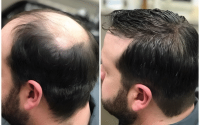 How Long Does a Non-Surgical Hair Replacement Session Take?